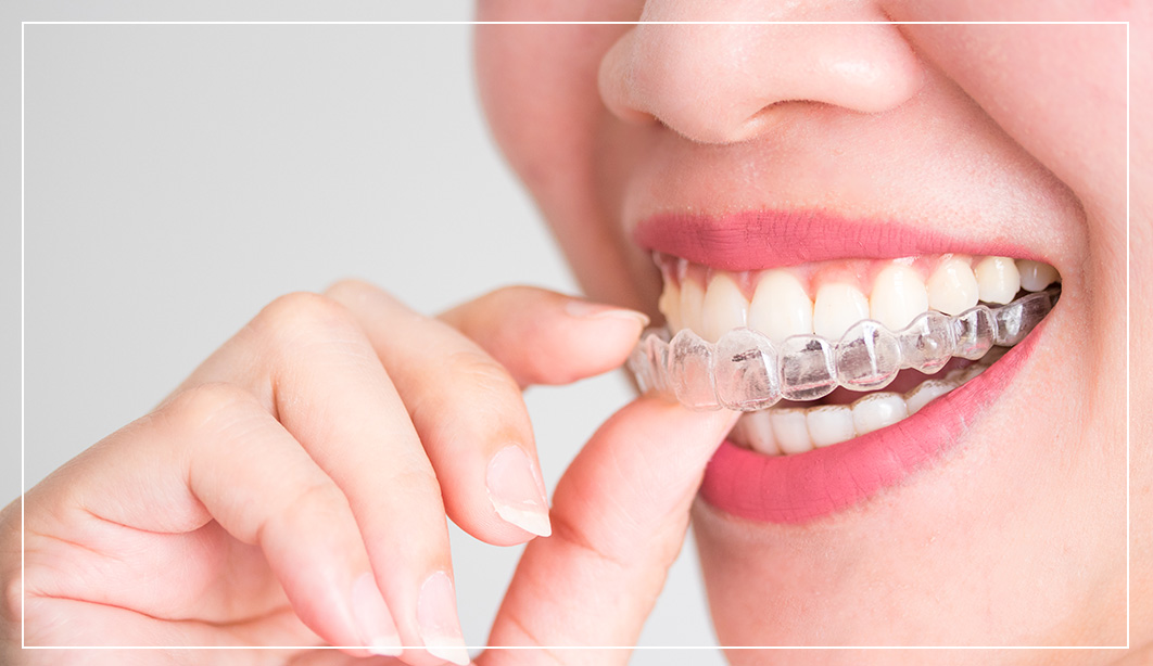 3invisalign_image_3