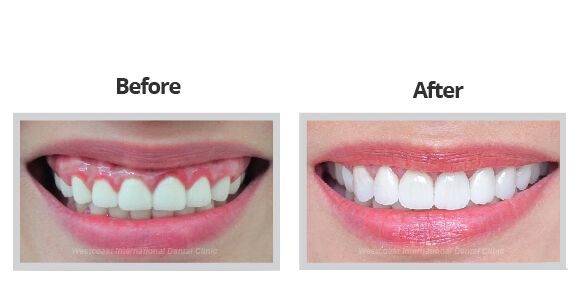 dental_BF