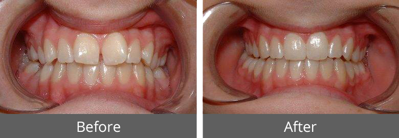 dental_straighting