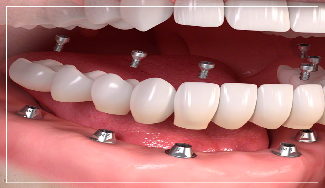 images-implants-2