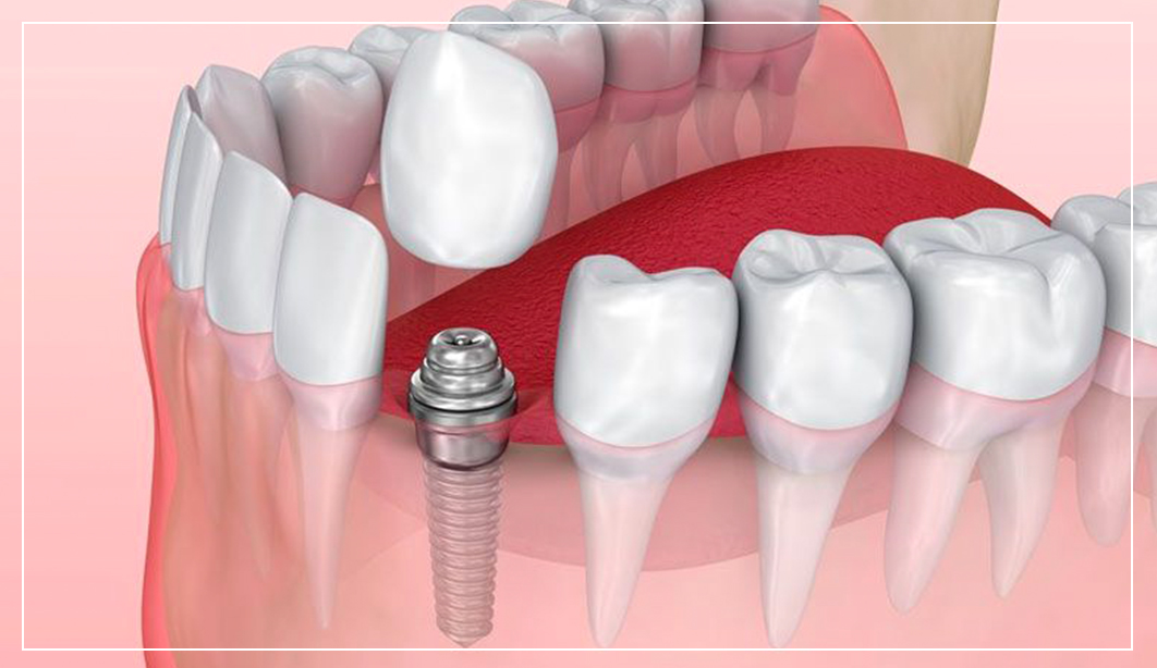 images-implants